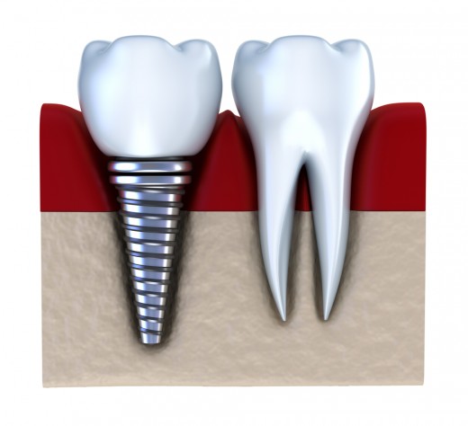 Имплантация стала уже хорошо отработанной технологией восстановления зубов