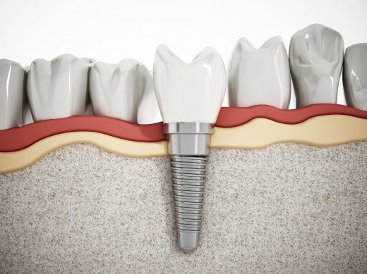 Сеть стоматологий «32 Дент» предлагает пациентам экспресс-имплантацию зубов