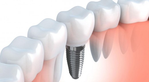 Зубная имплантация: полноценная замена утраченных зубов