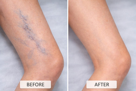 Лазерное лечение варикоза