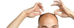 Особенности процедуры пересадки волос