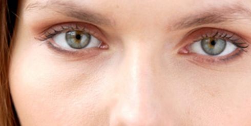 Тёмные круги под глазами: причины появления, лечение и результаты