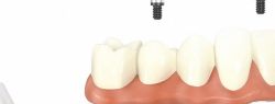 Имплантация зубов All-on-4 – новая улыбка в стоматологическом центре «Зууб»