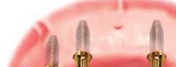 Новые возможности восстановления зубов: клиника «Зууб» запустила услугу «Все на шести»