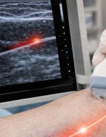 Лазерное лечение варикоза: преимущества и особенности процедуры